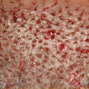 Nagy sűrűségű beültetés, implantáció Nagy sűrűségű beültetés, implantáció